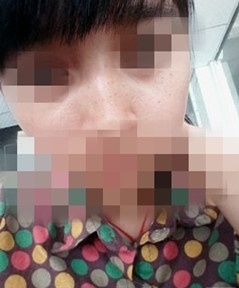 激光祛斑的恢復(fù)過程，逐步見證自己顏值的逐步提升。