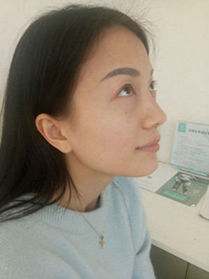 分享我的激光祛眼袋手術(shù)前后過程，廈門思明安黛美林韻醫(yī)生做的