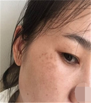 面部美白容整形激光祛斑手術(shù)恢復(fù)過程