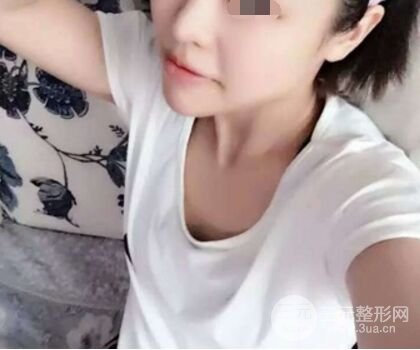 自體脂肪隆胸果超出預(yù)期,擁有**身材不是夢