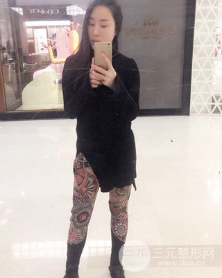 大腿吸脂前后對(duì)比照片,南昌永康王忠干真實(shí)案例分享