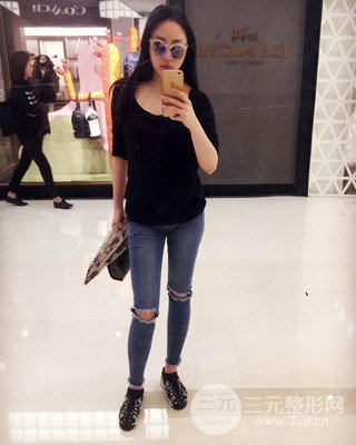 大腿吸脂前后對(duì)比照片,南昌永康王忠干真實(shí)案例分享