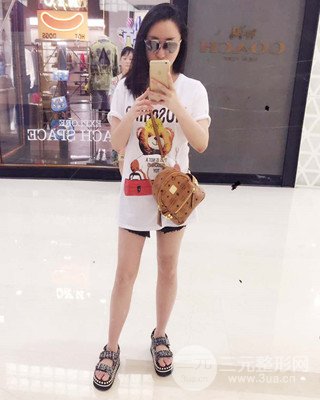大腿吸脂前后對(duì)比照片,南昌永康王忠干真實(shí)案例分享