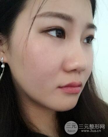 長沙鵬愛隆鼻整形果展示 恢復(fù)過程圖
