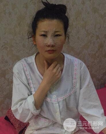 長沙鵬愛隆鼻整形果展示 恢復(fù)過程圖