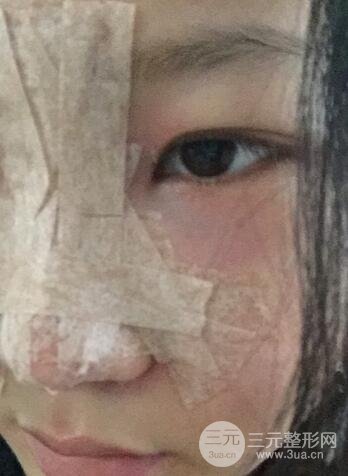 長沙鵬愛隆鼻整形果展示 恢復(fù)過程圖