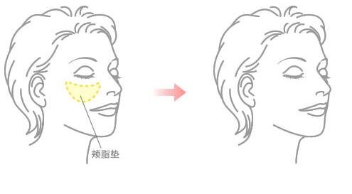 去頰脂墊果怎么樣 取頰脂墊手術前后對比照片