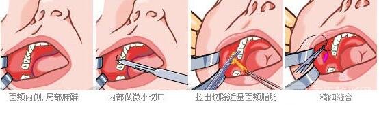 去頰脂墊果怎么樣 取頰脂墊手術前后對比照片