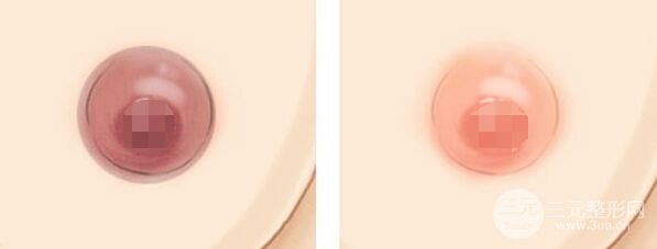乳暈黑怎么辦、乳暈漂紅術(shù)多少錢