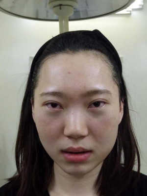 內(nèi)切祛眼袋手術(shù)真實(shí)案例，武漢天申胡麗醫(yī)生做的