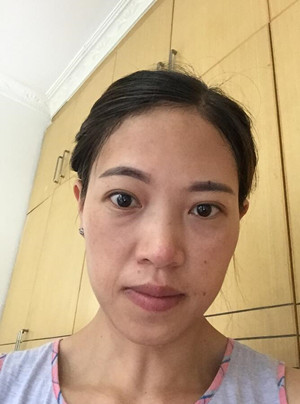 激光祛斑真實案例——武漢一美王朝輝醫(yī)生做的