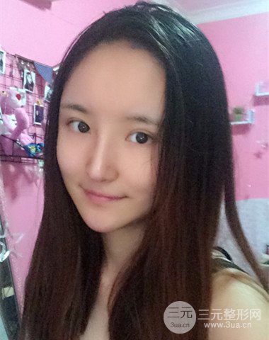 隆鼻整形+自體脂肪全臉填充前后變化實(shí)在驚人!