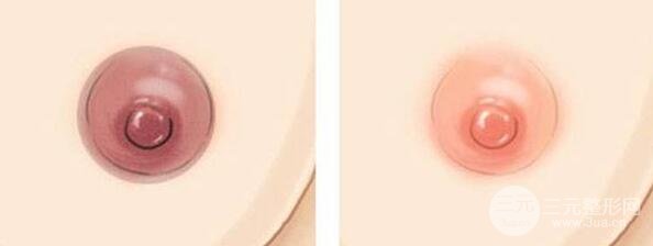 乳暈漂紅
