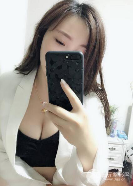 自體脂肪豐胸3個(gè)月分享,活細(xì)胞豐胸術(shù)后果逼真更自然