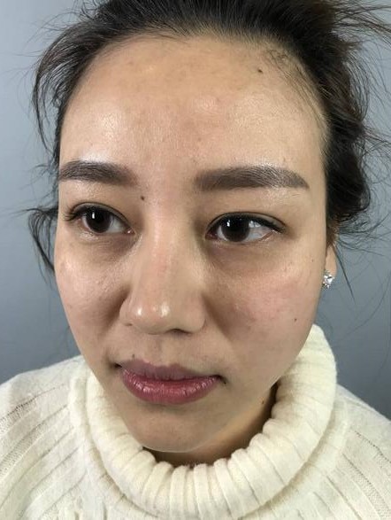 【高強度聚焦超聲面b提升術(shù)后照片】原來我的青春并沒有走遠~