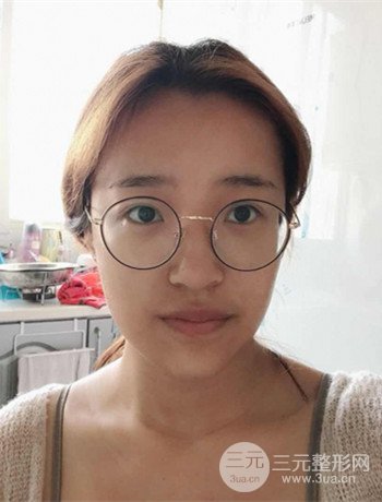 上海面部脂肪填充一個月果超明X、妥妥減齡十歲！