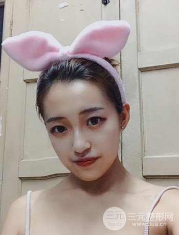 上海面部脂肪填充一個月果超明X、妥妥減齡十歲！