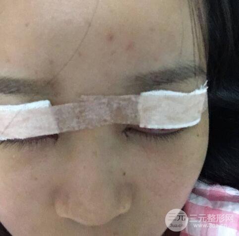 芭比電雙眼皮多項整形術(shù)后分享,雙眼皮拯救死魚眼!