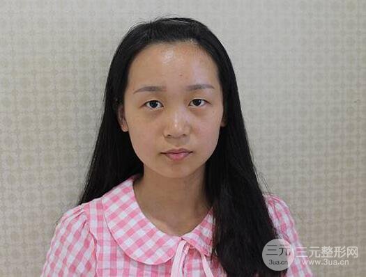 芭比電雙眼皮多項整形術(shù)后分享,雙眼皮拯救死魚眼!