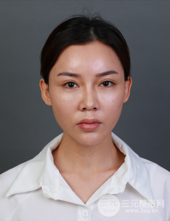 上海隆鼻失敗手術(shù)修復(fù)果超乎想象、前后對(duì)比照片分享