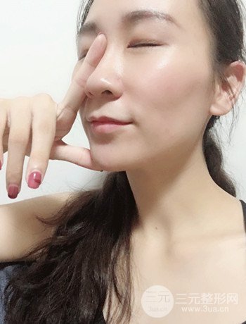 面部埋埋蛋白線.提升改良皮膚松弛,立現(xiàn)小V臉