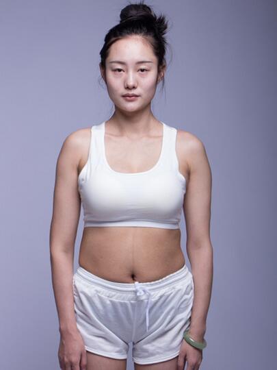 腰腹吸脂全身塑形案例，身輕如燕美出天際~