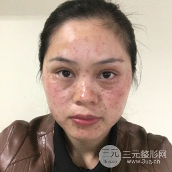 廣州激光祛雀斑果不反彈、恢復(fù)過程圖片分享