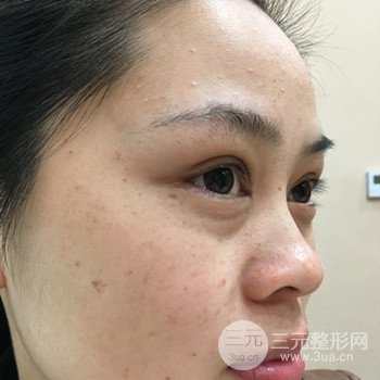 廣州激光祛雀斑果不反彈、恢復(fù)過程圖片分享