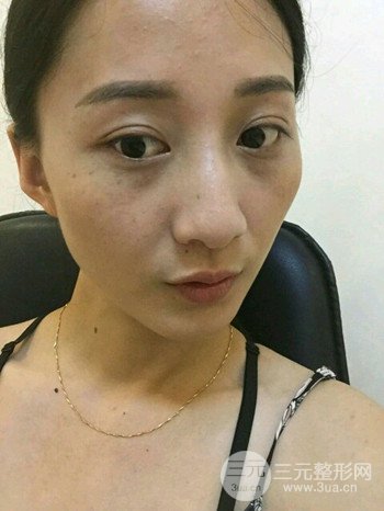 朱彤玥激光祛斑案例、兩個(gè)月果對(duì)比超明X