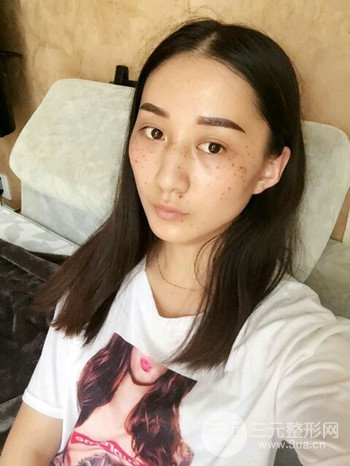 朱彤玥激光祛斑案例、兩個(gè)月果對(duì)比超明X