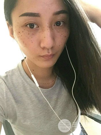 朱彤玥激光祛斑案例、兩個(gè)月果對(duì)比超明X