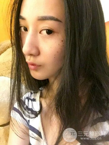 朱彤玥激光祛斑案例、兩個(gè)月果對(duì)比超明X