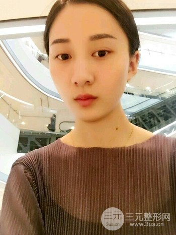 朱彤玥激光祛斑案例、兩個(gè)月果對(duì)比超明X