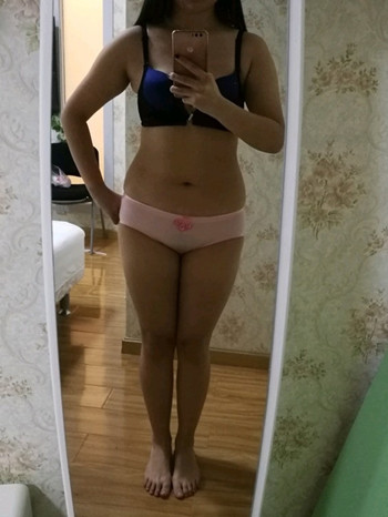 濟南腰腹吸脂案例三個月前后變化圖片分享