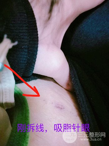 濟南腰腹吸脂案例三個月前后變化圖片分享