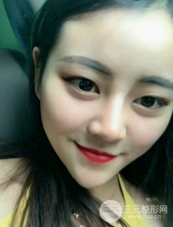西安切開雙眼皮開眼角手術(shù)案例恢復(fù)過程圖分享