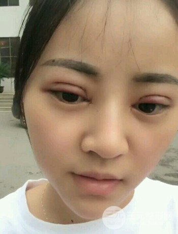 西安切開雙眼皮開眼角手術(shù)案例恢復(fù)過程圖分享