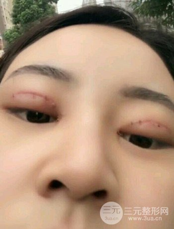 西安切開雙眼皮開眼角手術(shù)案例恢復(fù)過程圖分享