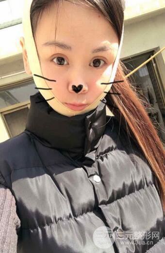 磨骨瘦臉(下頜角切除)恢復(fù)過程及前后對比照片