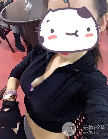 蘇州假體隆胸手術案例分享、前后對比圖分享