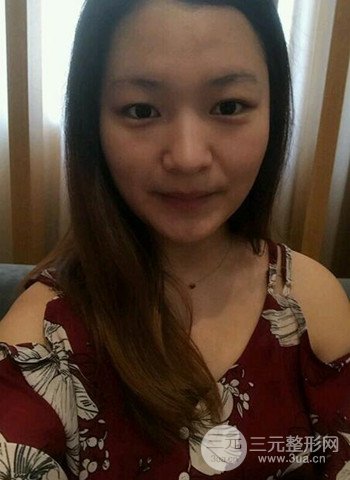 深圳雙眼皮正就內(nèi)雙小眼睛,真實案例前后對比照片