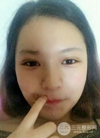 深圳雙眼皮正就內(nèi)雙小眼睛,真實案例前后對比照片