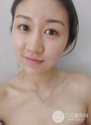 廣州隆鼻整形真實(shí)恢復(fù)期圖片,擁有精致美鼻不是夢(mèng)