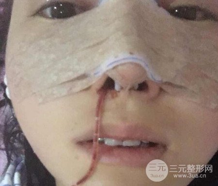 廣州隆鼻整形真實(shí)恢復(fù)期圖片,擁有精致美鼻不是夢(mèng)