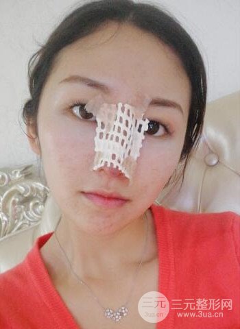 廣州隆鼻整形真實(shí)恢復(fù)期圖片,擁有精致美鼻不是夢(mèng)