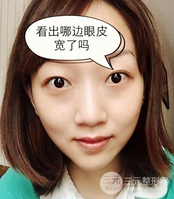 北京雙眼皮失敗修復手術日記分享,附上前后對比照片