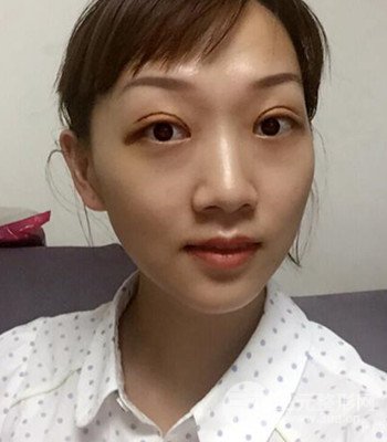 北京雙眼皮失敗修復手術日記分享,附上前后對比照片
