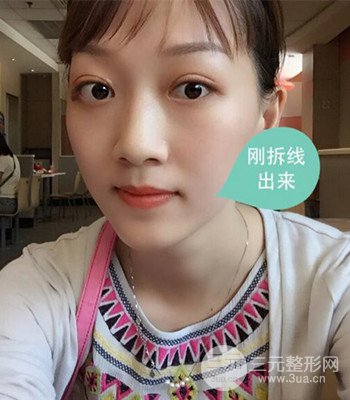 北京雙眼皮失敗修復手術日記分享,附上前后對比照片