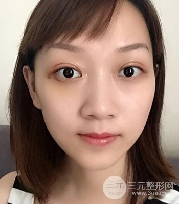 北京雙眼皮失敗修復手術日記分享,附上前后對比照片