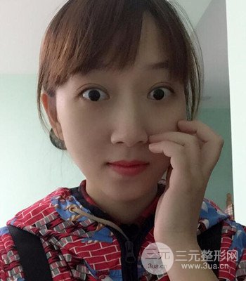 北京雙眼皮失敗修復手術日記分享,附上前后對比照片